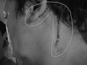 Cicatrice et fils de suture